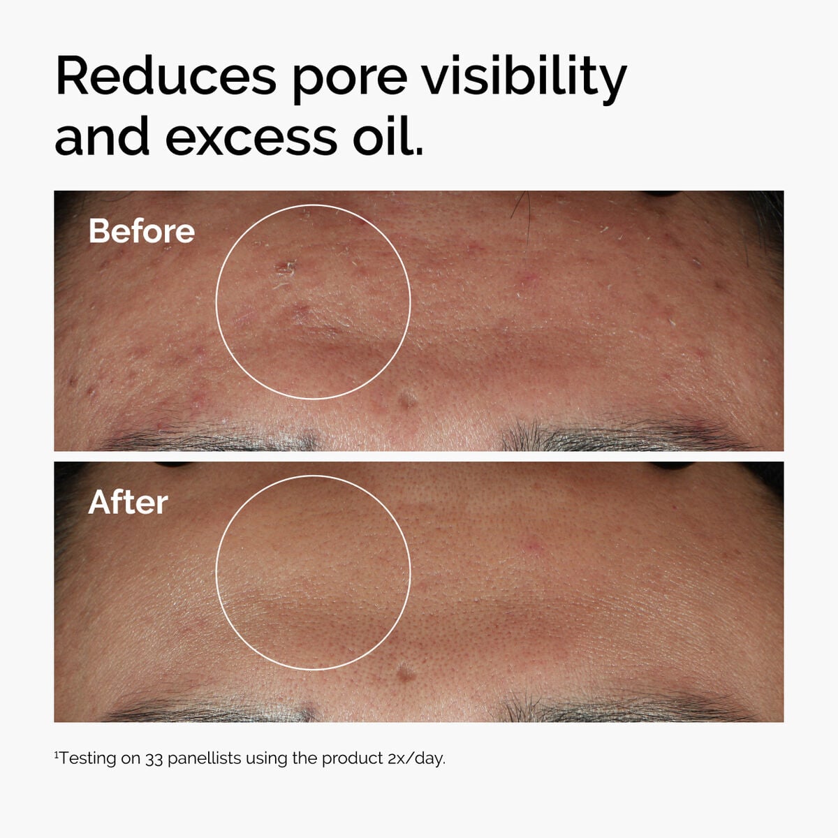 niacinamide-10-zinc-1-f1 ord-niacinamide-zinc-blemish-serum-before-after-pores.jpg