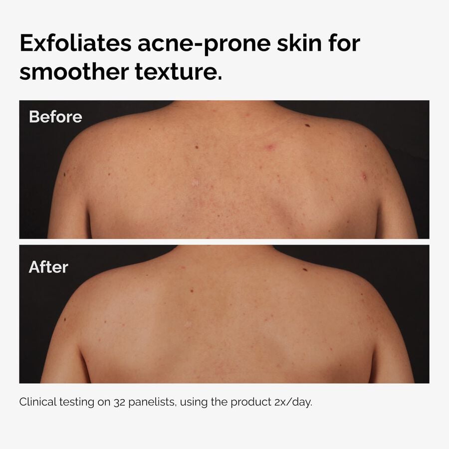 the-body-care-collection-m7 ord-salicylic-acid-body-serum-before-after-graphic-NA.jpg